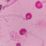 The Ultimate Guide to Urinary Tract Infections: Symptoms, Causes, Treatment, and Prevention