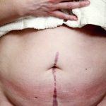 The Ultimate Guide to Vasectomy: Separating Fact from Fiction
