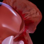 The Enlarged Prostate Conundrum: Understanding Benign Prostatic Hyperplasia and Taking Control of Your Health