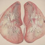 Title: “Seeing Red in the Bathroom? A Complete Guide to Understanding, Managing, and Preventing Hematuria”