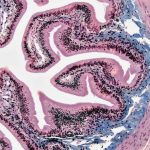 Managing Prostate Enlargement: Practical Steps for Men